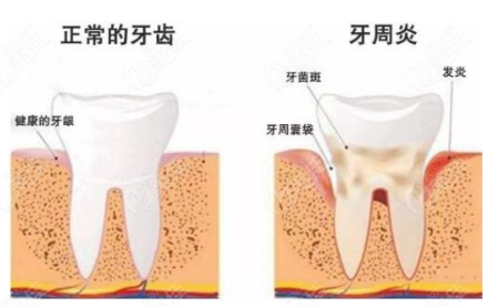 孕期遇上牙周炎如何应对