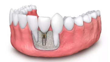 深圳种植牙多颗种植牙怎么样？