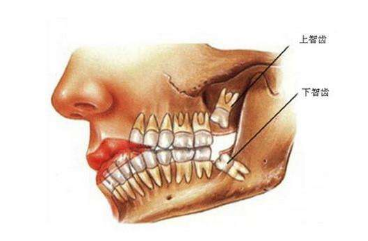 长智齿会造成的牙列拥挤吗