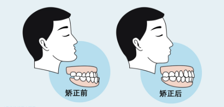 牙齿反颌需要矫正吗