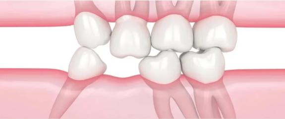 牙齿缺失有哪些修复方式